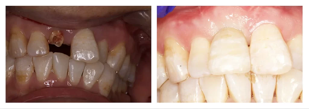 Before and after Front tooth implant