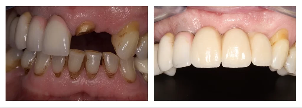 Before and after Full arch restoration