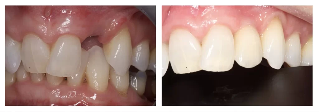 Before and after Single tooth implant